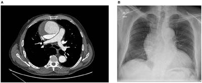 Case Report: Are We Witnessing an Increase of Chronic Ascending Aortic Dissection as a Collateral Effect to the COVID-19 Pandemic?